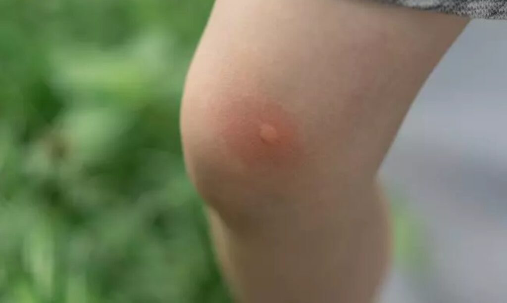 Inseto maruim é responsável por surto de Oropouche na Amazônia Ocidental.