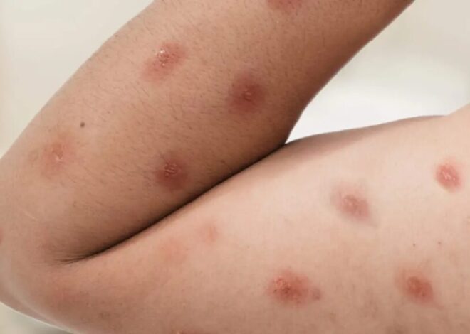 Como se prevenir da Mpox: Brasil acumula 88 casos em 2026