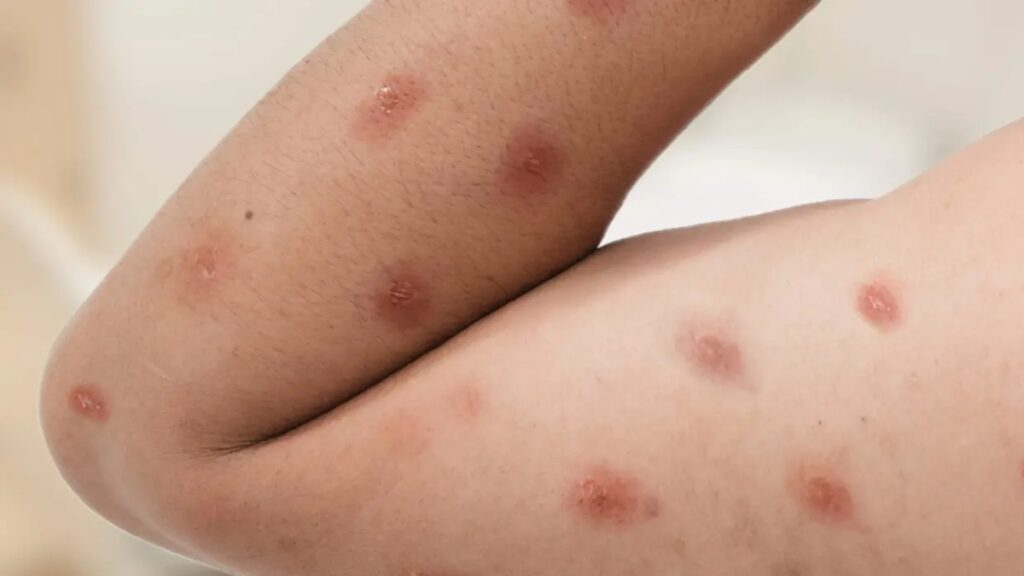 Como se prevenir da Mpox: Brasil acumula 88 casos em 2026